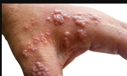 Documents from 2021 Int’l Security Exercise Showed Monkeypox Bio Attack on May 15, 2022